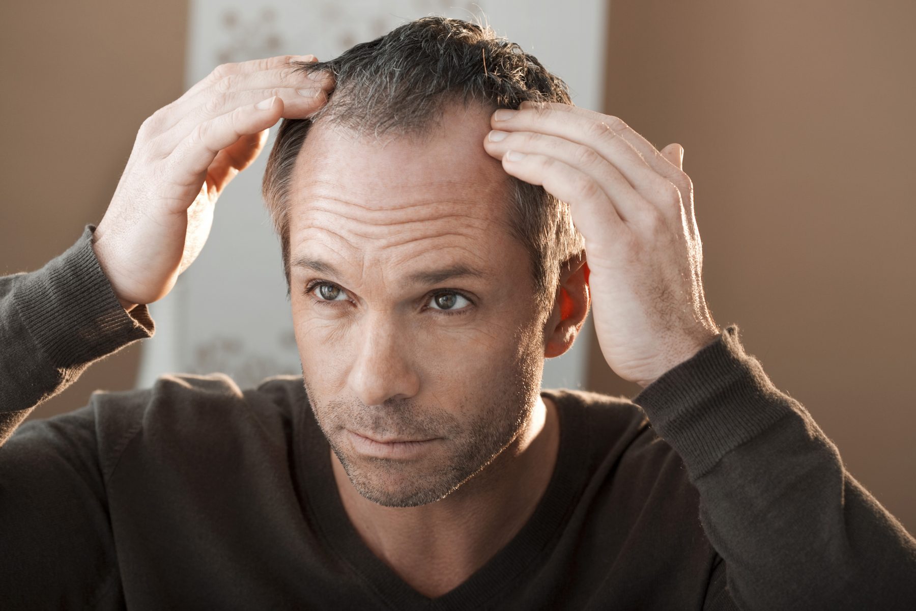 Man with with Alopecia with hair falling out