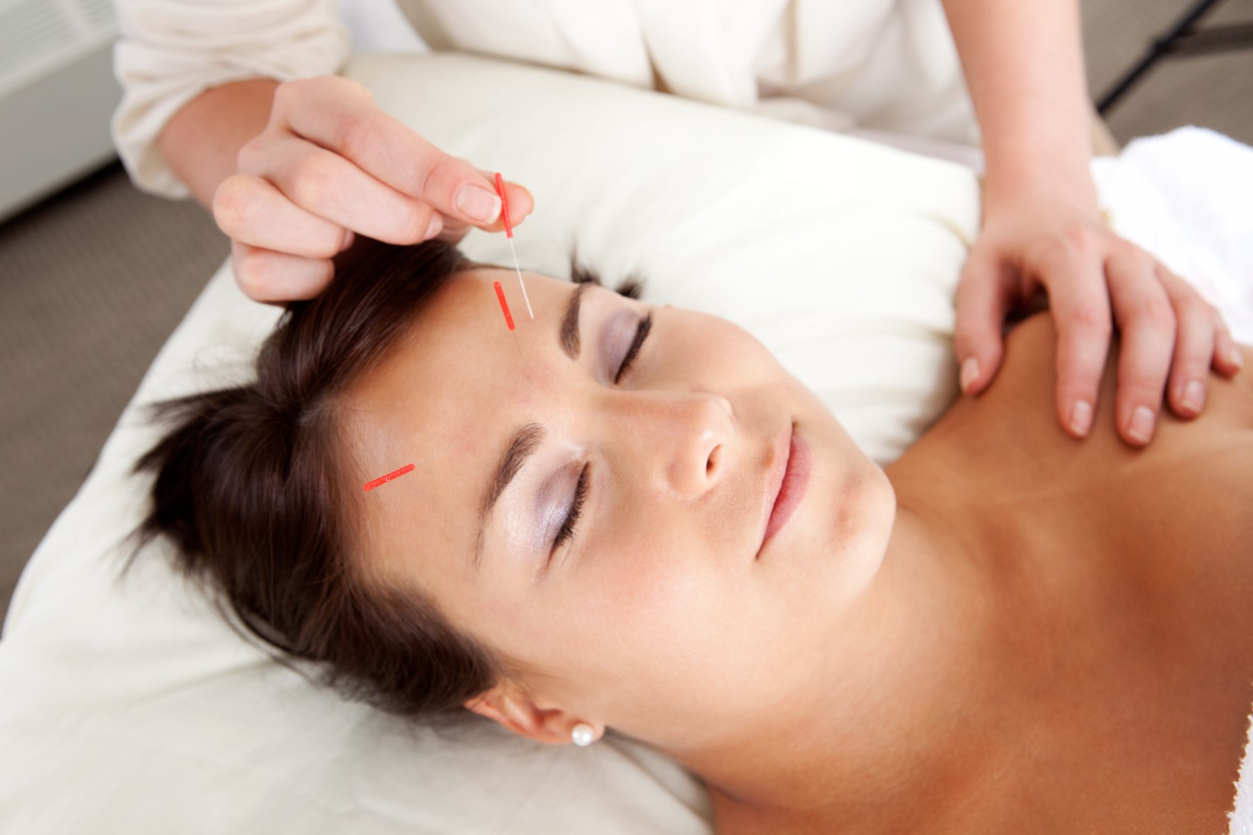 Young woman getting an acupuncture facial