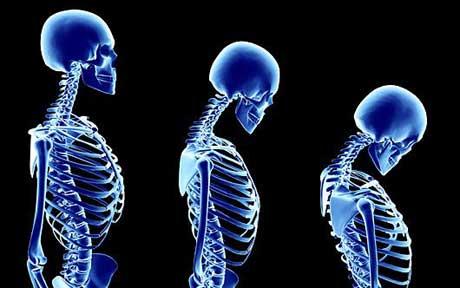 Computer simulated series of skeletons showing the progression of osteoporosis